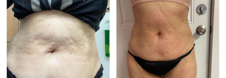 Lipo sin cirugia